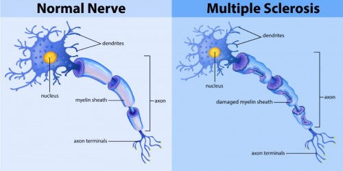 Defining Multiple Sclerosis: What’s the Role of Myelin, Immune-mediated Disease And T-Cells